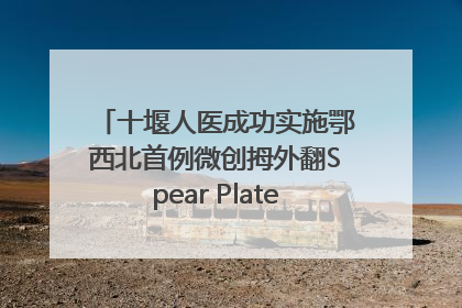 十堰人医成功实施鄂西北首例微创拇外翻Spear Plate髓内板矫形术